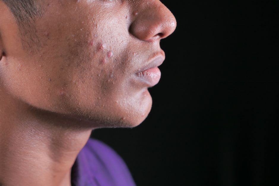 This startup is issuing AI-generated acne prescriptions