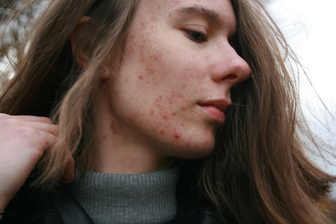 This startup is issuing AI-generated acne prescriptions